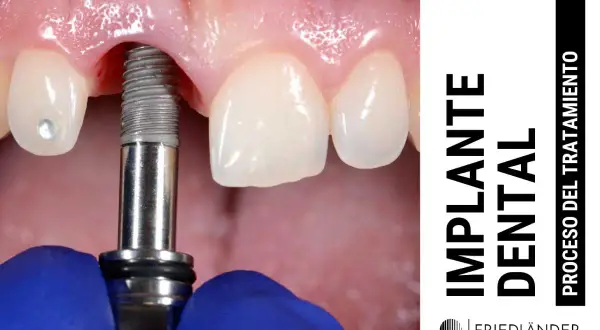 Proceso de colocación de un implante dental. Un tornillo metálico se inserta en la encía, cerca de dientes naturales.