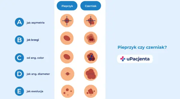 Porównanie cech pieprzyka i czerniaka: asymetria, brzegi, kolor, średnica i ewolucja.
