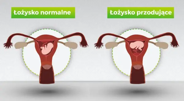 Porównanie: łożysko normalne vs łożysko przodujące. Grafika pokazuje macicę z płodem, ilustrując różnice w położeniu łożyska.