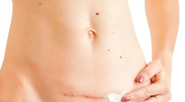 Frau trägt eine Creme auf eine Narbe am Bauch auf. Natürliche Hausmittel für die Narbenpflege können hier helfen.