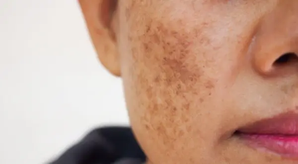 Gros plan sur une joue montrant une tache brune soleil, signe d'une exposition passée au soleil.
