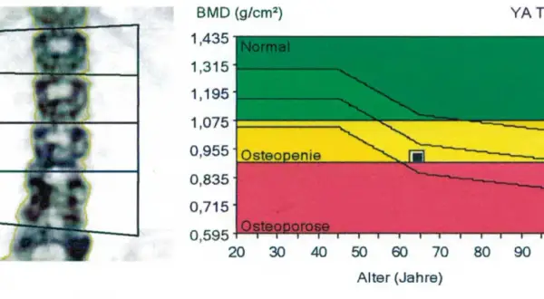 Osteoporose werte tabelle: Röntgenaufnahme der Lendenwirbel und eine Grafik, die den T-Wert im Verhältnis zum Alter zeigt. Grün: Normal, Gelb: Osteopenie, Rot: Osteoporose.