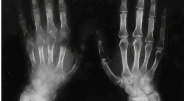 RTG dłoni ukazujący zmiany kostne charakterystyczne dla zespołu sudeckiego. Widoczne są objawy osteoporozy, obrzęki i zwężenia przestrzeni stawowych.