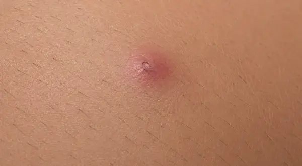 Primo piano di un pelo incarnito, un piccolo brufolo rosso sulla pelle. Ecco come togliere un pelo incarnito.