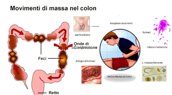 Illustrazione del colon con feci, che mostra movimenti di massa. Diverse cause di diarrea e stitichezza sono elencate, tra cui ipertiroidismo, allergie alimentari e infezioni.