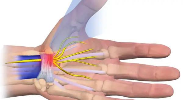 Illustrazione anatomica dei nervi del polso, evidenziando la compressione e l'infiammazione dei nervi che si diramano verso le dita.