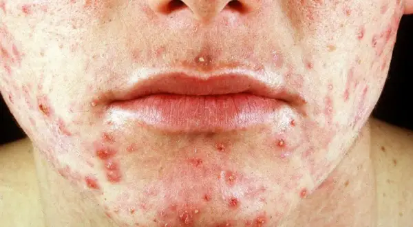 Nahaufnahme eines Gesichts mit starker Akne, Rötungen und Pickeln. Diese mallorca-akne bilder zeigen die Hautirritation.