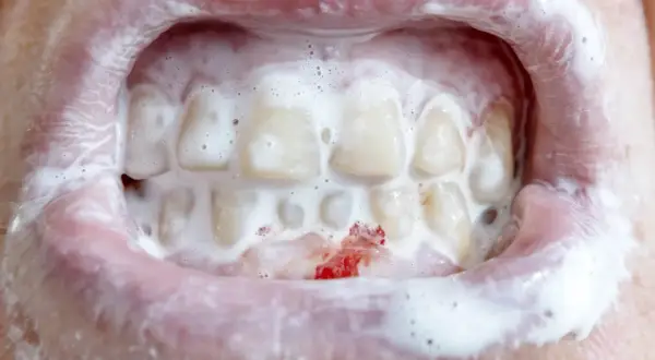 Krwawiące dziąsła i piana na zębach. To może być objaw problemów, którymi zajmuje się periodontologia. Co to jest?