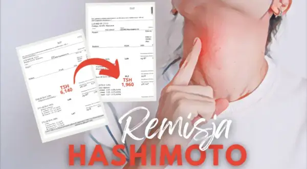 Czy choroba Hashimoto kwalifikuje do renty? Sprawdź kryteria i możliwości