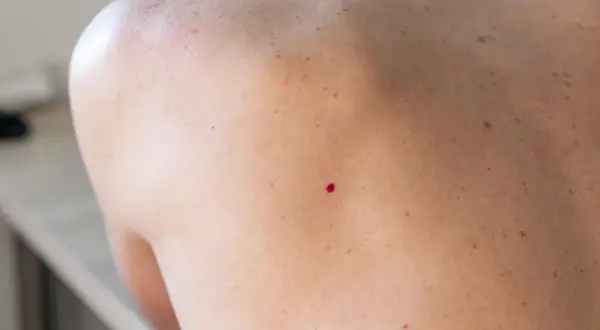 Skóra z pieprzykami i jednym wyraźnym, czerwonym naczyniakiem rubinowym.
