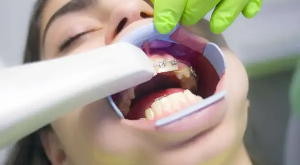 Dentysta zakłada aparat ortodontyczny. Dowiedz się, ile trwa zakładanie aparatu i jak przebiega wizyta.