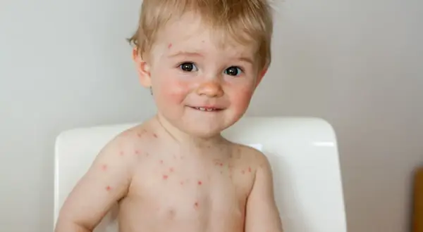 Czy dziecko ze strupami po ospie może iść do przedszkola? Fakty