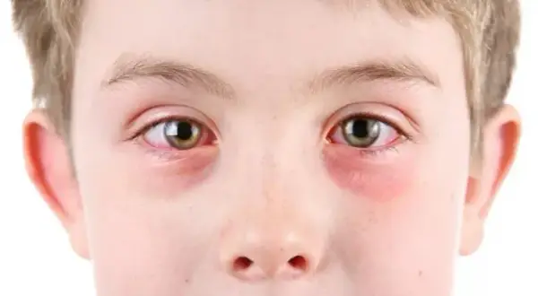Alergia oczu: objawy, rozpoznanie i skuteczne sposoby na ulgę