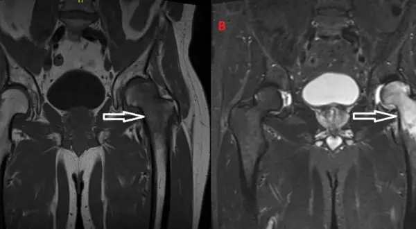 Risonanza magnetica pelvica: edema osseo nel femore sinistro, che potrebbe indicare un tumore.