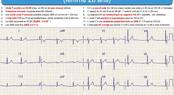 Électrocardiogramme (ECG) d'une femme de 28 ans, montrant un cycle cardiaque normal avec des ondes P, QRS et T caractéristiques.