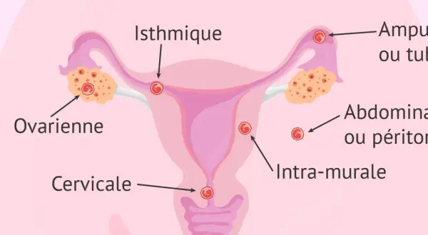 Schéma illustrant les différents sites d'une grossesse extra-utérine : ovarienne, isthmique, ampullaire, abdominale, cervicale et intra-murale.
