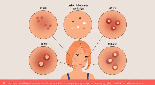 Ilustracja przedstawia różne rodzaje trądziku, w tym krosty, grudki i guzki, które mogą pojawić się na skórze.