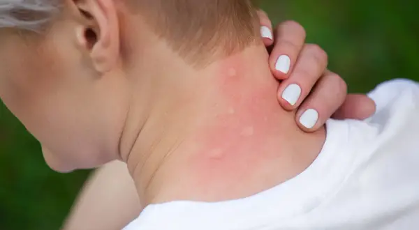 Rote, geschwollene Stellen am Hals, deutliche Anzeichen einer starken Schwellung nach Insektenstich.
