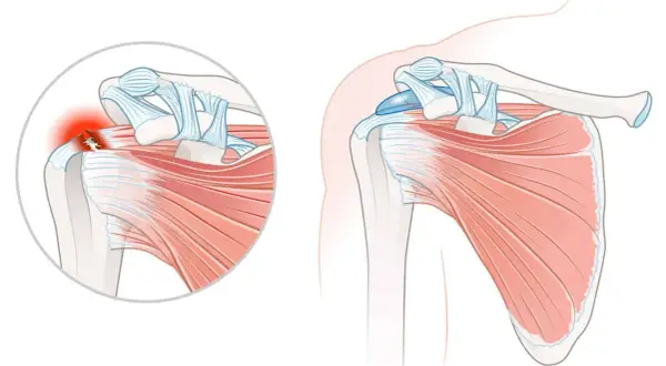Schulteransicht mit Darstellung einer Tendinopathie der Supraspinatussehne, die entzündet und gerissen ist.