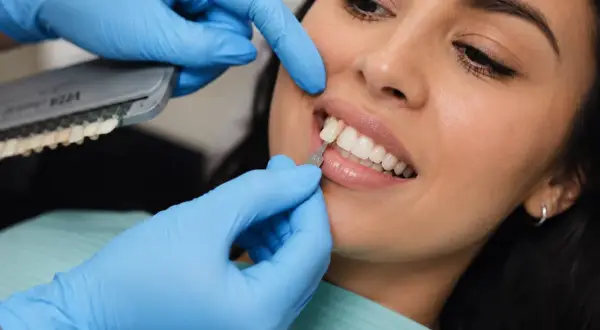 Dobór idealnego odcienia żywicy kompozytowej na zęby. Dentysta porównuje kolor zęba z wzornikiem.