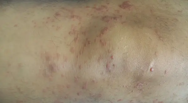 Hautveränderungen, die auf Mycosis fungoides hindeuten, zeigen sich als rote, schuppige Flecken und Plaques am Bein.