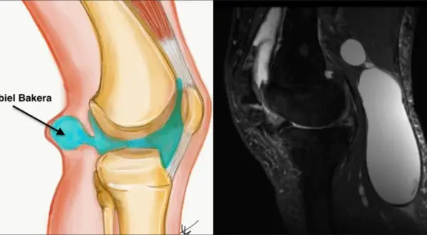 Ilustracja anatomiczna i rezonans magnetyczny ukazują torbiel Bakera w dole podkolanowym, wypełnioną płynem.