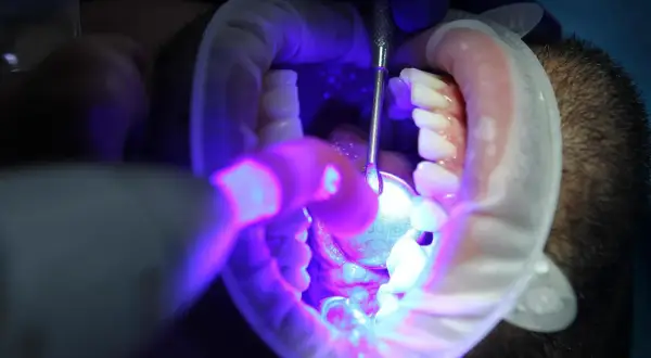 Zatrucie zęba bez leczenia kanałowego. Dentysta bada ząb pod lampą UV, używając narzędzi i rozwieraka.