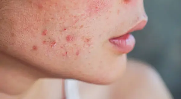 Gros plan sur une joue avec des rougeurs et des marques d'acné, suggérant des solutions pour comment enlever les cicatrices de boutons.