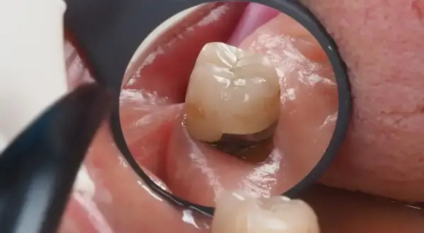 Widok z lusterka dentystycznego na ząb z widoczną koroną kompozytową, która chroni go przed dalszym uszkodzeniem.