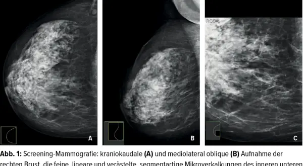Mammografie-Aufnahmen zeigen feine, lineare Mikroverkalkungen in der Brust.