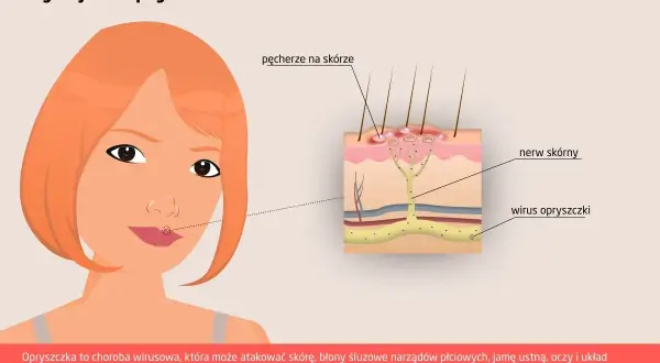 Jak zapobiegać opryszczce? Skuteczna profilaktyka i dieta