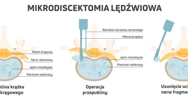 Ilustracja pokazuje mikrodiscektomię lędźwiową, zabieg leczenia rwy kulszowej. Widzimy przepuklinę krążka międzykręgowego uciskającą nerw.