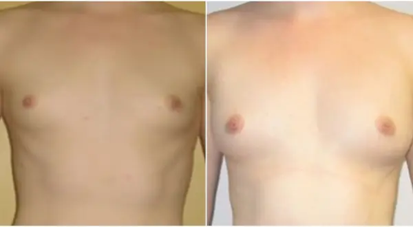 Przed i po lipotransferze biustu: widoczne powiększenie i wymodelowanie piersi. Efekty lipotransferu biustu są widoczne.