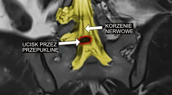 Zaburzenia korzeni rdzeniowych i splotów nerwowych - co to oznacza?
