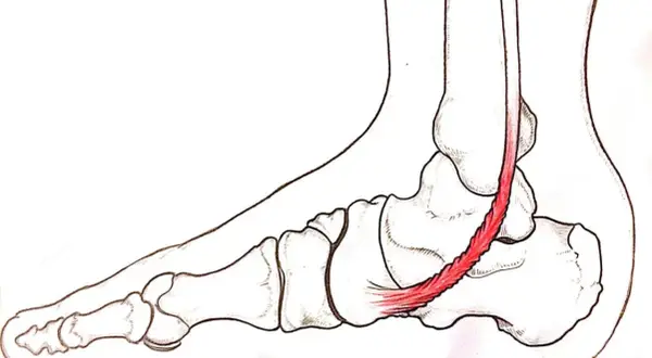 Illustrazione anatomica del piede con tendine d'Achille infiammato, evidenziando la **tendinite caviglia**.