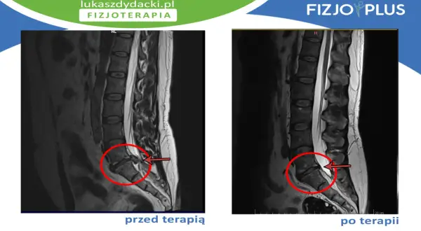 Przed i po terapii: rezonans magnetyczny kręgosłupa z widoczną dyskopatią L5/S1, która po leczeniu uległa poprawie.