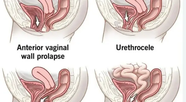 Illustrations de prolapsus vaginal. La question "peut-on avoir des rapports avec un prolapsus" est complexe et dépend de la sévérité.