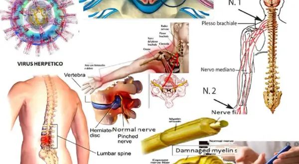 Immagine illustra cause di dolore neuropatico e neuropatia periferica: virus, compressione nervosa, ernia del disco, danni alla mielina.