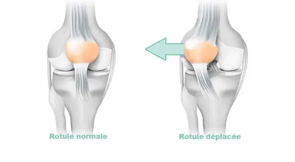 Comparaison d'une rotule normale et d'une rotule déplacée, illustrant la **dysplasie femoro patellaire**.