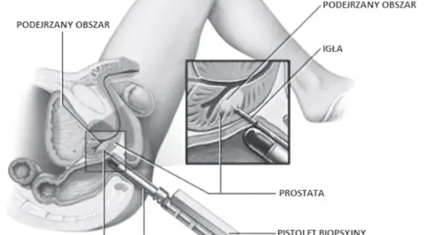 Biopsja prostaty: Co musisz wiedzieć? Przebieg, przygotowanie, wyniki