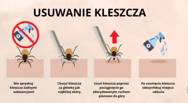 Jak bezpiecznie usunąć kleszcza? Sprawdzony poradnik krok po kroku