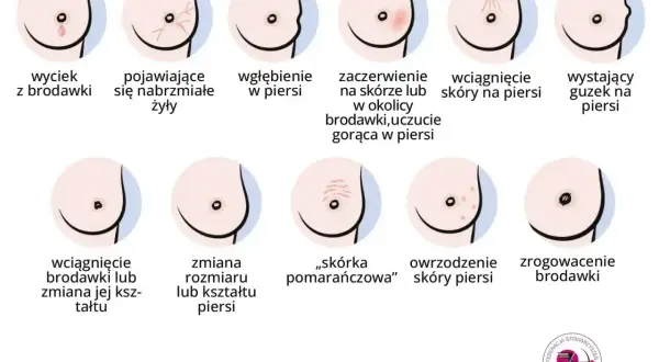Ilustracja pokazuje różne zmiany w piersiach, w tym wyciek z brodawki, zaczerwienienie, wgłębienie, guzek, zmiany skórne i zrogowacenie.