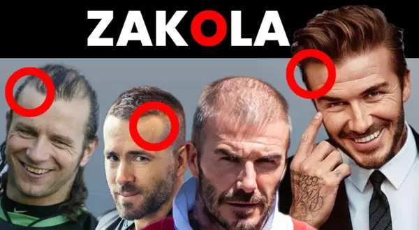ZAKOLA. Czterech mężczyzn z widocznym łysieniem androgenowym, zaznaczone czerwonymi okręgami. Fryzura w kontekście utraty włosów.