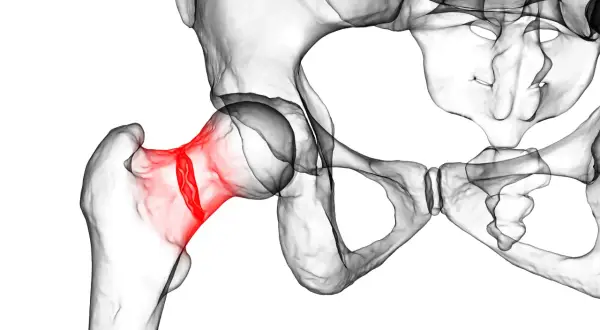3D-Darstellung des menschlichen Beckens mit rot hervorgehobenem Oberschenkelhalsbruch, eine häufige Verletzung im Alter.