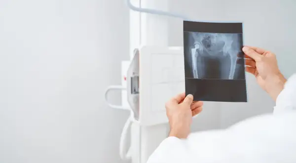 Lekarz analizuje RTG miednicy z endoprotezą stawu biodrowego. Czy USG czy RTG lepsze? RTG pokazuje kości i implant.