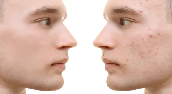Gesichtsprofil links: reine Haut. Rechts: Akne-Ausbrüche, die durch Omega-3-Fettsäuren verbessert werden könnten.