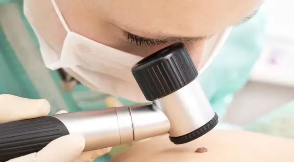 Lekarz bada pieprzyk dermatoskopem. Czy usuwanie pieprzyka boli? Zależy od metody i znieczulenia.