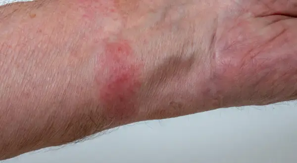 Pelle arrossata e irritata sul polso, sintomo di dermatite da contatto. Quanto dura? Dipende dalla causa.