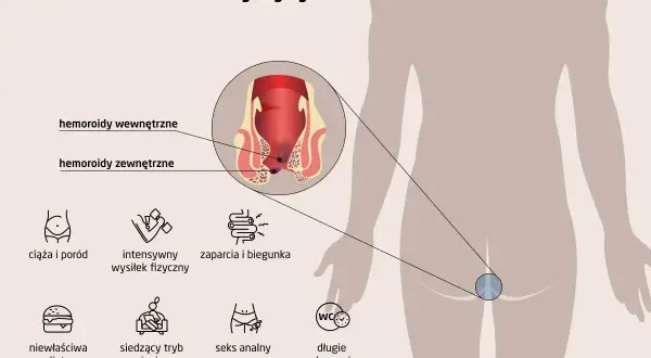Ilustracja pokazuje przyczyny hemoroidów: ciążę, wysiłek fizyczny, zaparcia, dietę, siedzący tryb życia, seks analny, długie przebywanie w toalecie. Hemoroidy wyleczyłam.
