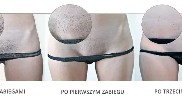 Depilacja laserowa bikini: przewodnik krok po kroku i efekty